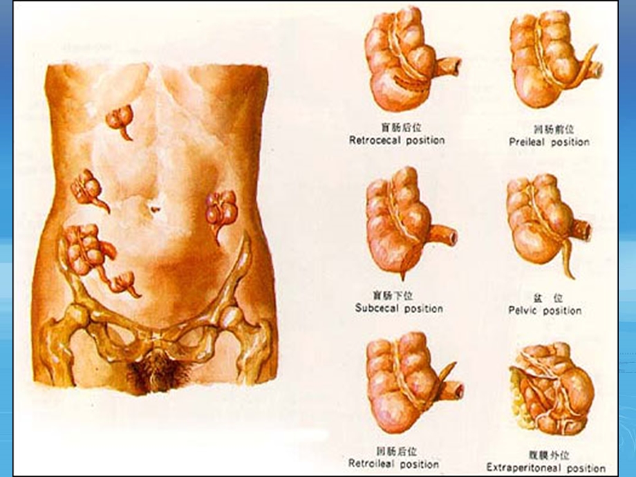 《阑尾及阑尾炎》PPT课件.ppt_第3页