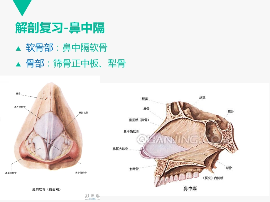 《鼻中隔偏曲》PPT课件.ppt_第2页