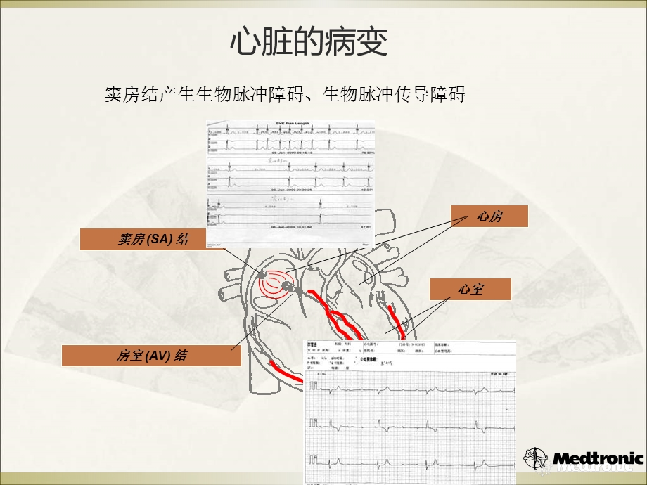 起搏治疗的电学基础.ppt_第3页