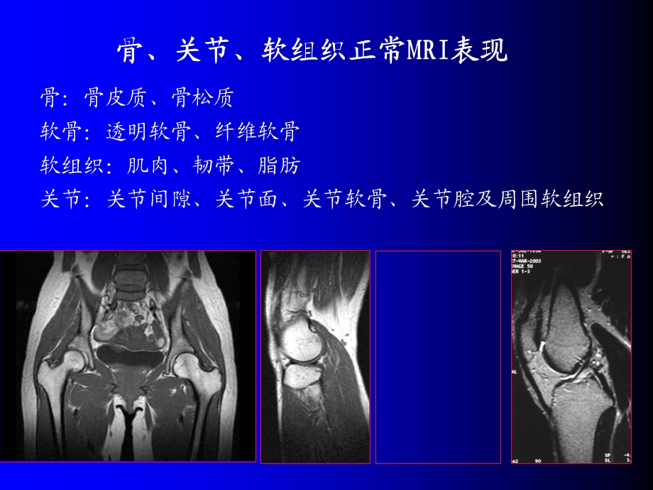 磁共振成像诊断 骨、关节及软组织疾病.ppt_第3页