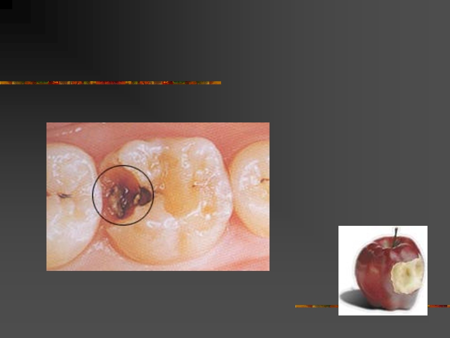 《龋病病因》PPT课件.ppt_第3页