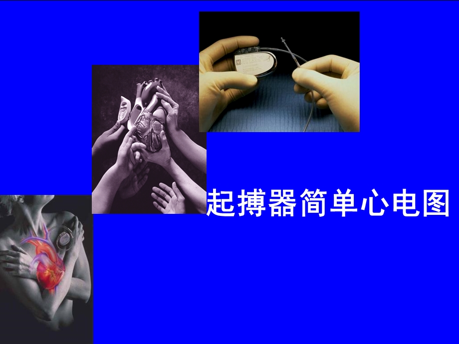 《起搏器心电图》PPT课件.ppt_第1页