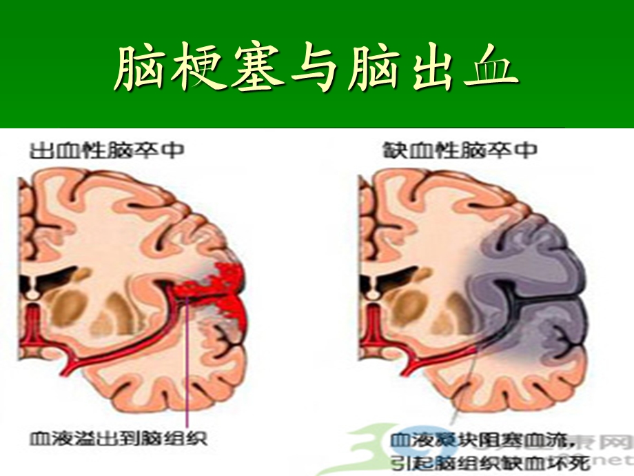 赵村乡卫生院高血压性脑出血防治知识讲座.ppt_第2页