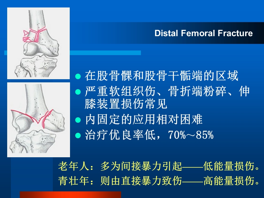 《股骨远端骨折》PPT课件.ppt_第2页