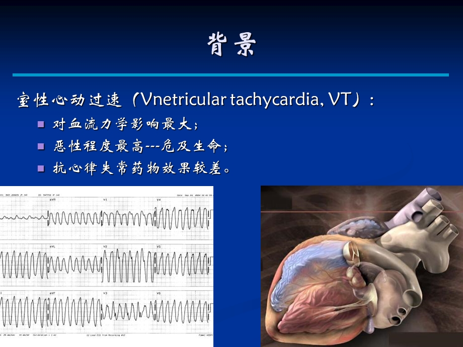 《室速的诊断及治疗》PPT课件.ppt_第2页