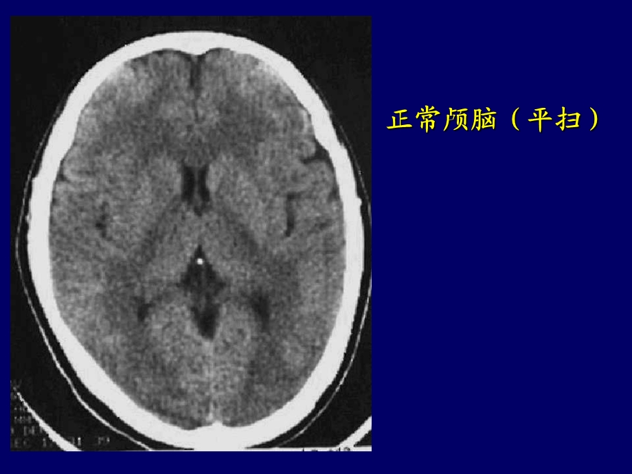 《颅脑ct诊断读》PPT课件.ppt_第2页