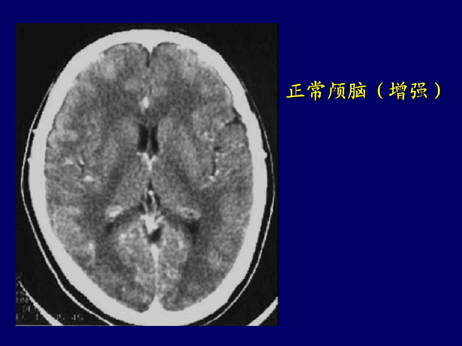 《颅脑ct诊断读》PPT课件.ppt_第3页