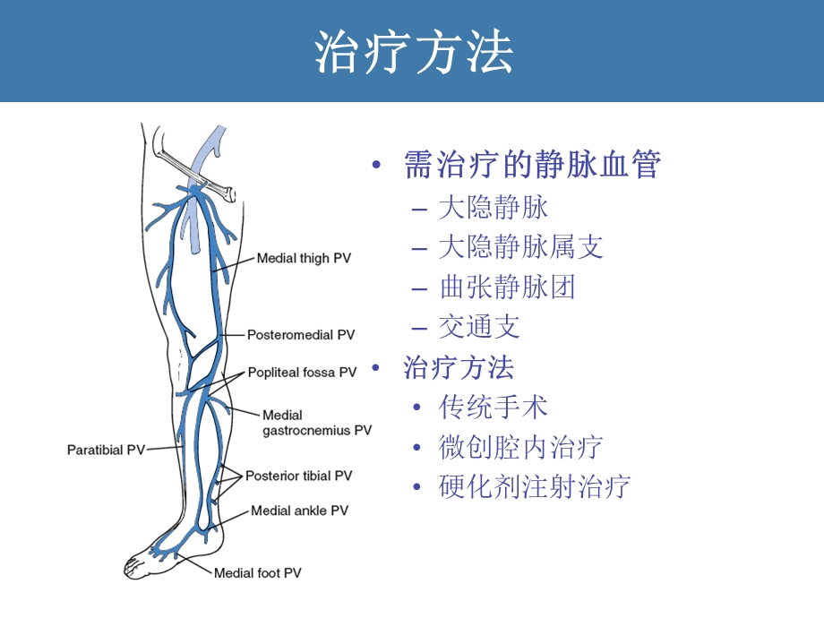 静脉曲张的微创治疗.ppt_第3页