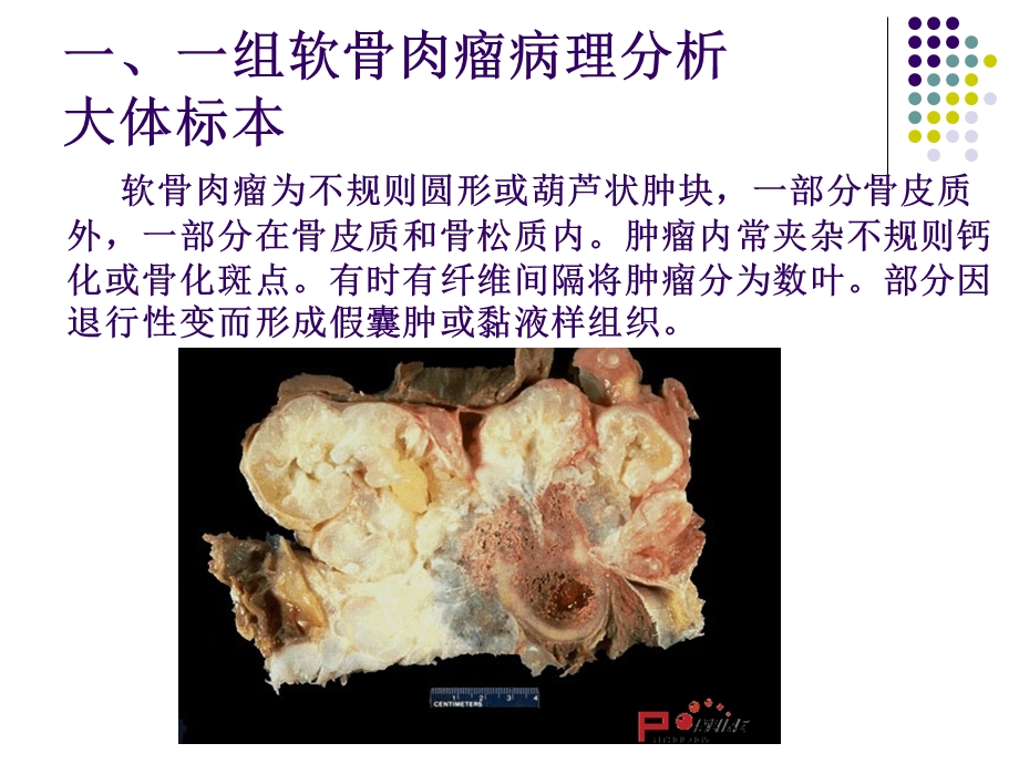 软骨肉瘤的病理及影像学表现.ppt_第1页