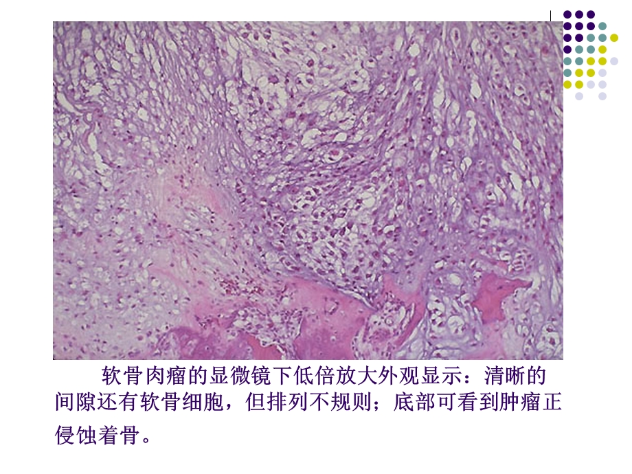 软骨肉瘤的病理及影像学表现.ppt_第3页