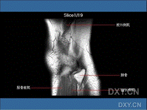 膝关节MRI.ppt