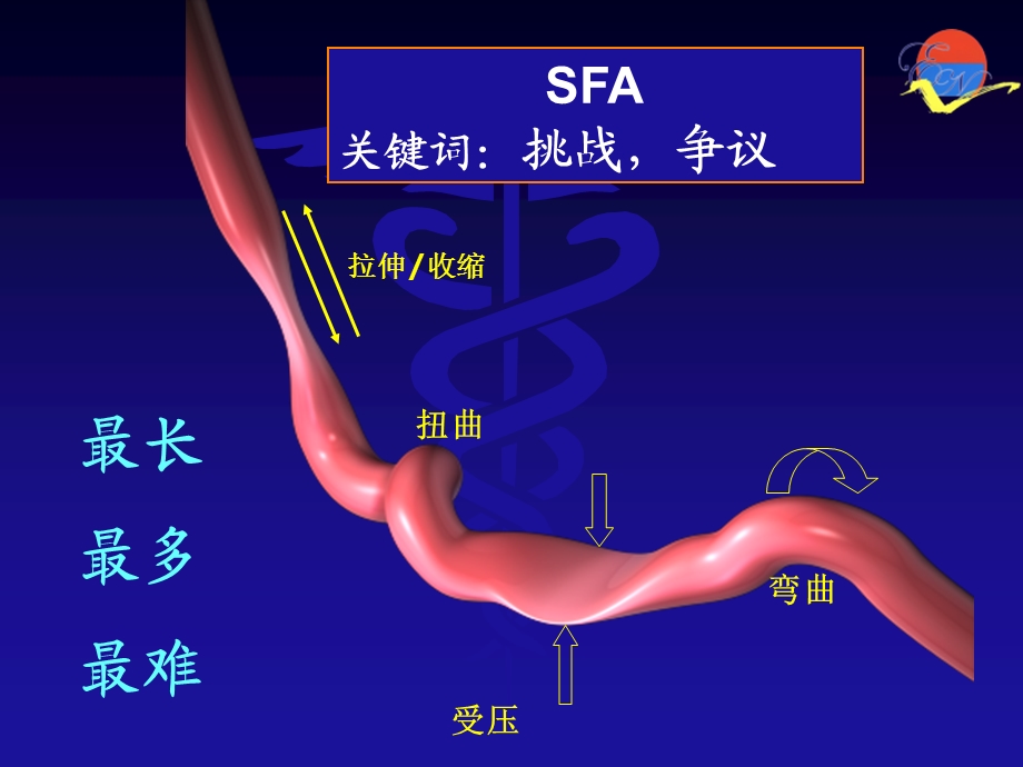 股浅动脉CTO的腔内治疗课件.ppt_第2页