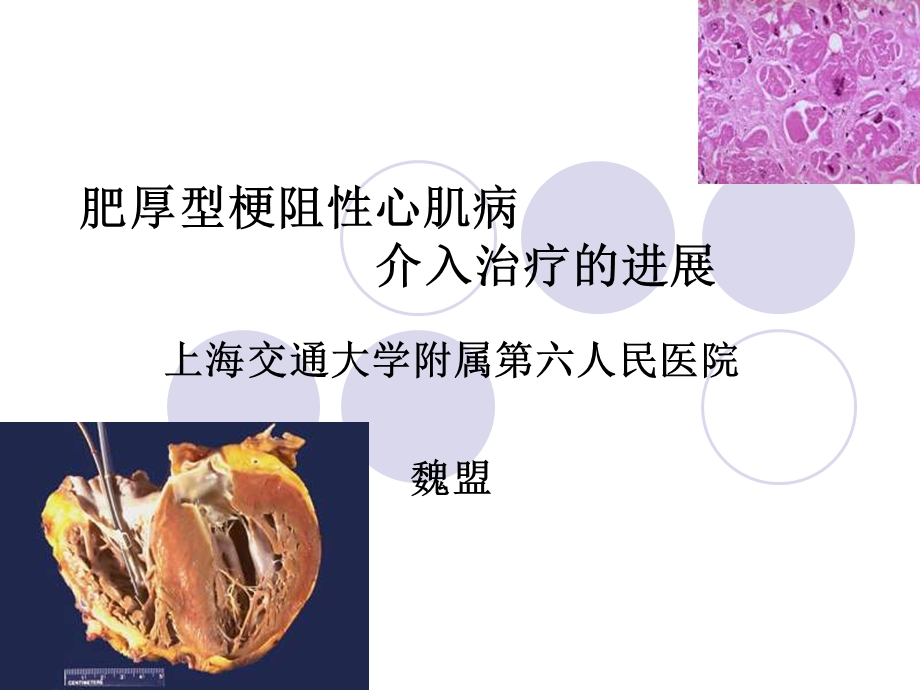 肥厚型梗阻心肌病介入治疗的进展教学课件.ppt_第1页