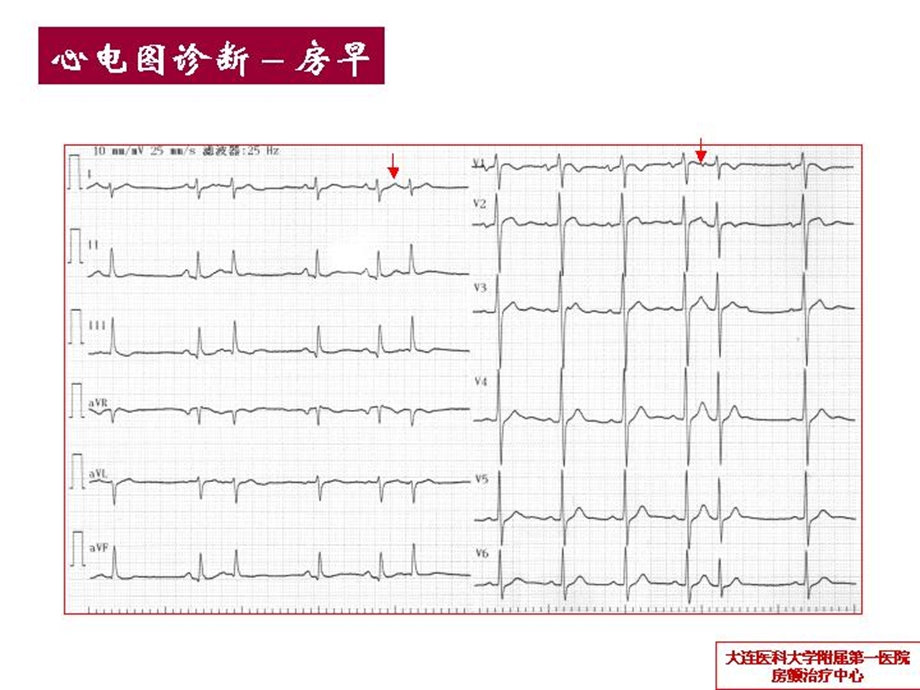 《肌袖性心律失常》PPT课件.ppt_第2页