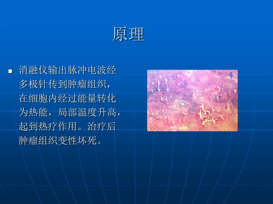 经皮穿刺射频消融治疗肺肿瘤.ppt_第3页