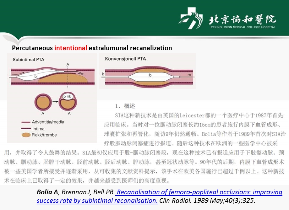 股浅动脉闭塞病变的介入治疗内膜下技术学习体会.ppt_第2页