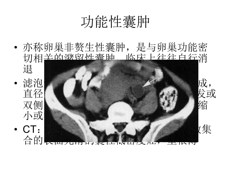 卵巢良性病变.ppt_第3页