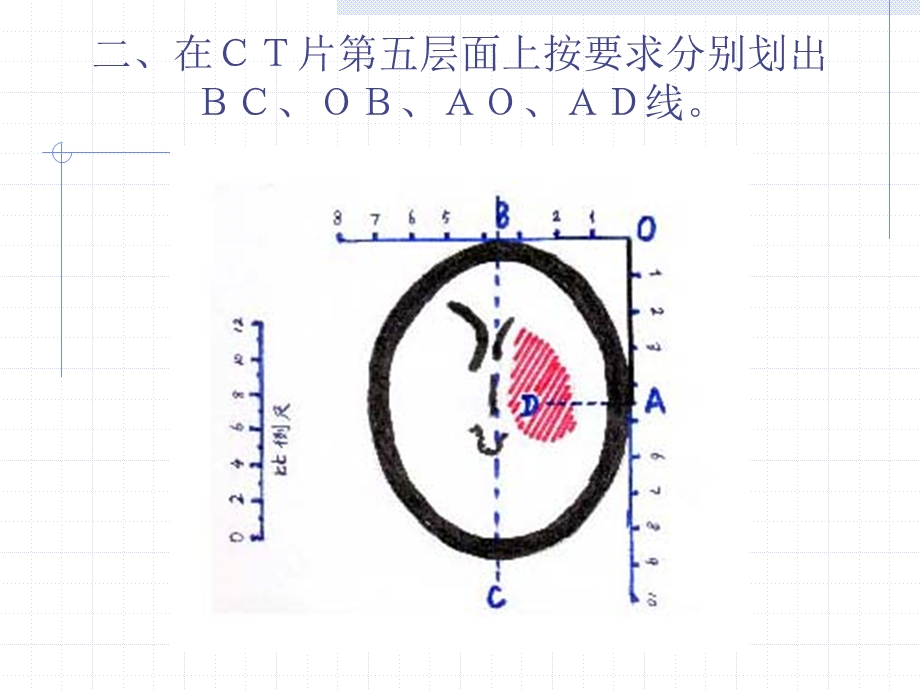 颅内血肿ＣＴ片定位ppt课件.ppt_第3页