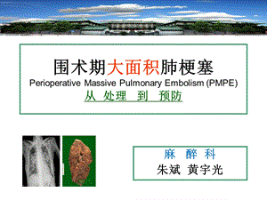 麻醉科围术期大面积肺梗塞for各科主任at医务处.ppt