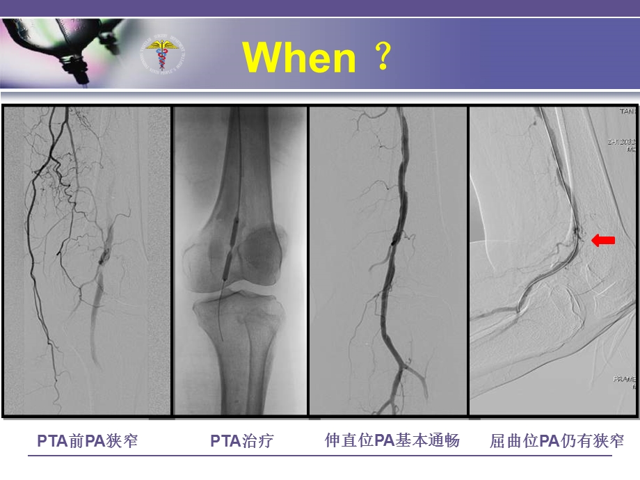 腘动脉ASO支架成形术whenwherehow课件.ppt_第3页