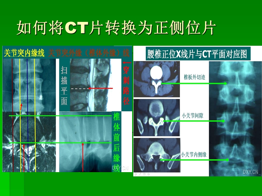 射频穿刺技术.ppt_第3页