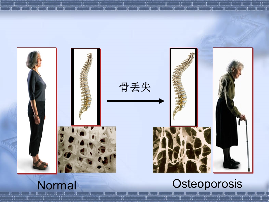 骨质疏松社区教育.ppt_第1页