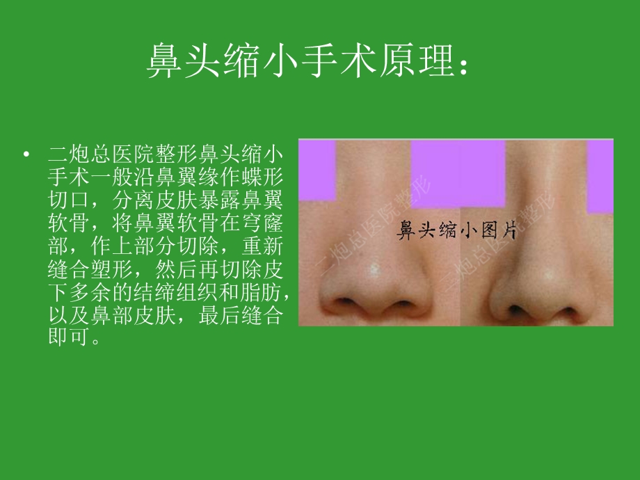 《鼻头缩小手术》PPT课件.ppt_第3页