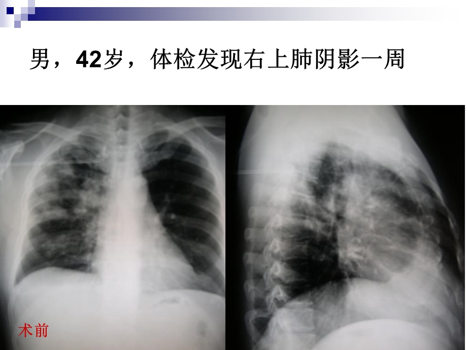 《肺隐球菌型肉芽肿》PPT课件.ppt_第2页