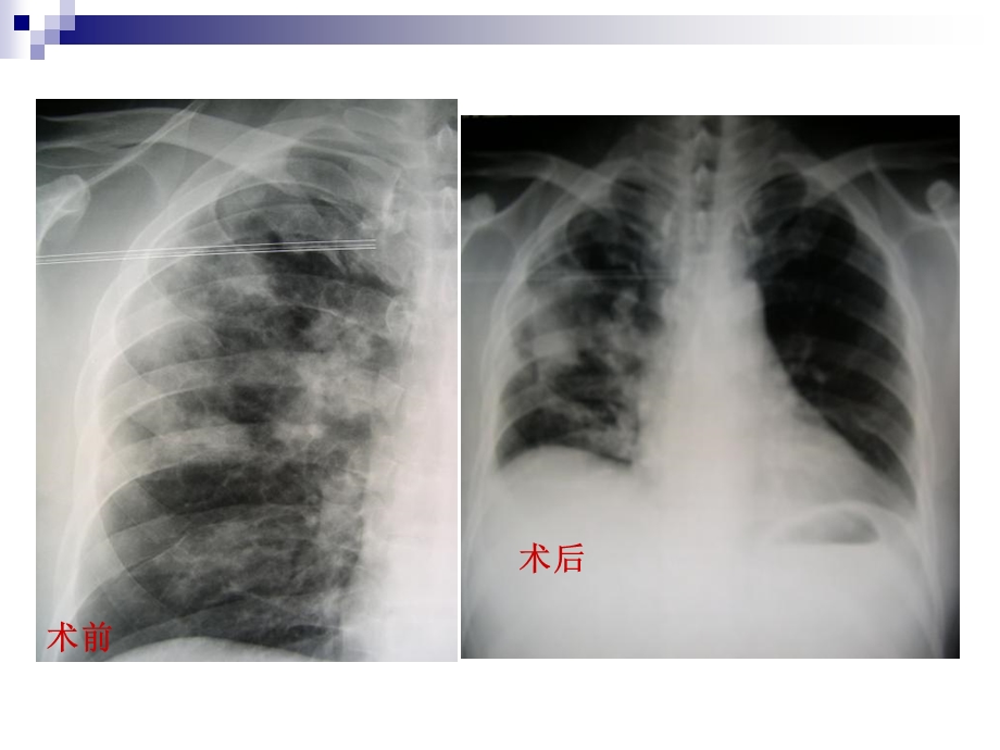 《肺隐球菌型肉芽肿》PPT课件.ppt_第3页