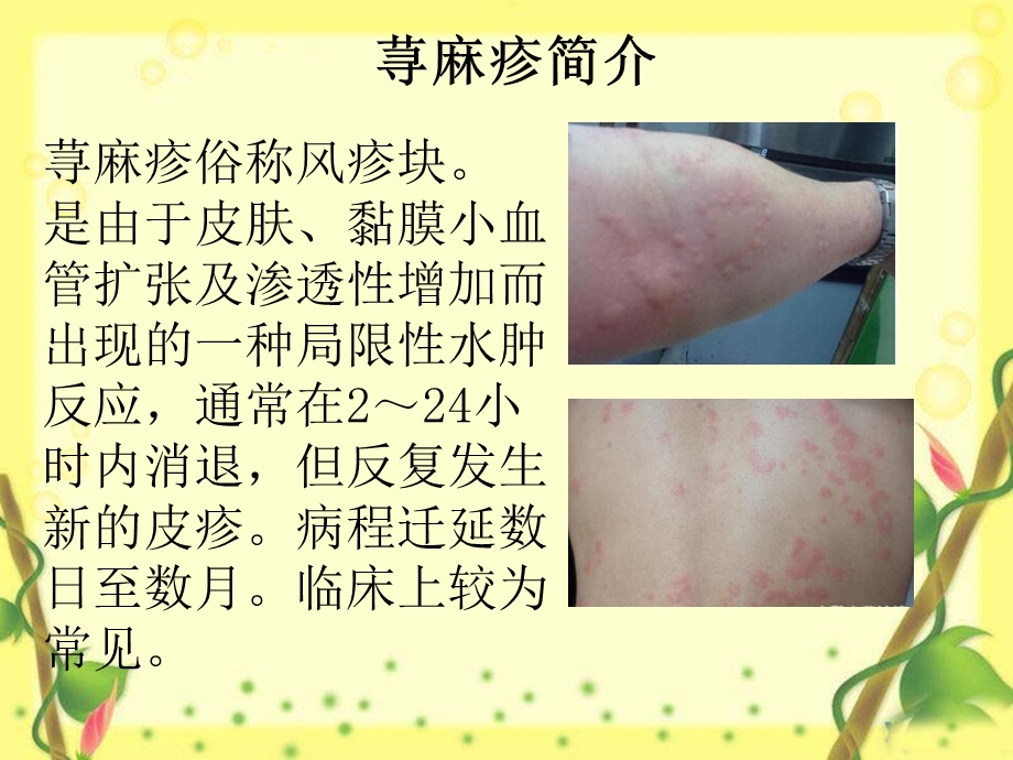 慢性荨麻疹不能吃什么.ppt_第3页