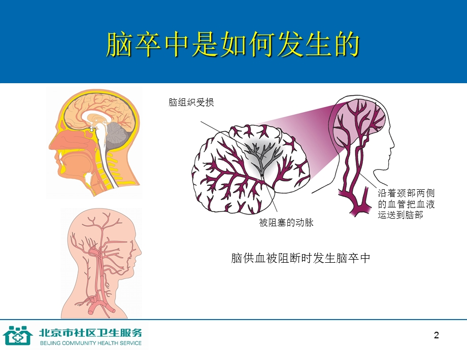 第十一讲防治脑卒中.ppt_第2页