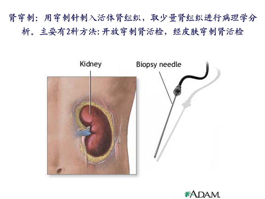 《肾穿刺活检》PPT课件.ppt_第2页