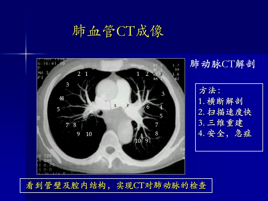 肺血管病的多排螺旋CT诊断.ppt_第2页