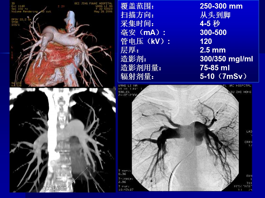 肺血管病的多排螺旋CT诊断.ppt_第3页