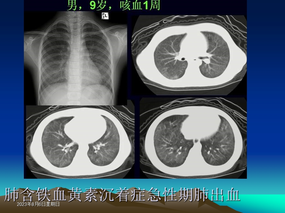 胸部少见疾病影像诊断.ppt_第2页