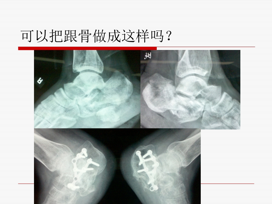 跟骨骨折ORIF的技巧PPT课件ppt课件.ppt_第3页