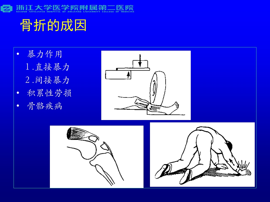 骨骼损伤概论.ppt_第3页