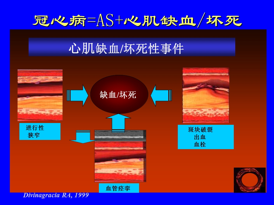 非ST段抬高型ACSNSTEACS危险评估与介入治疗时机.ppt_第2页