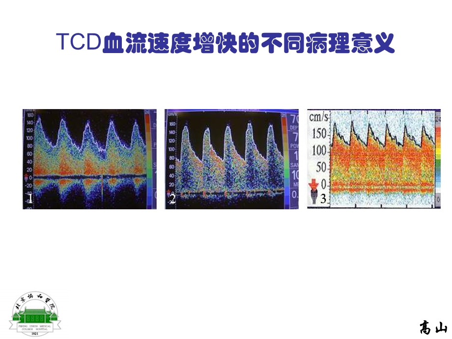 脑血流速度增快或减慢的病理生理意义.ppt_第3页