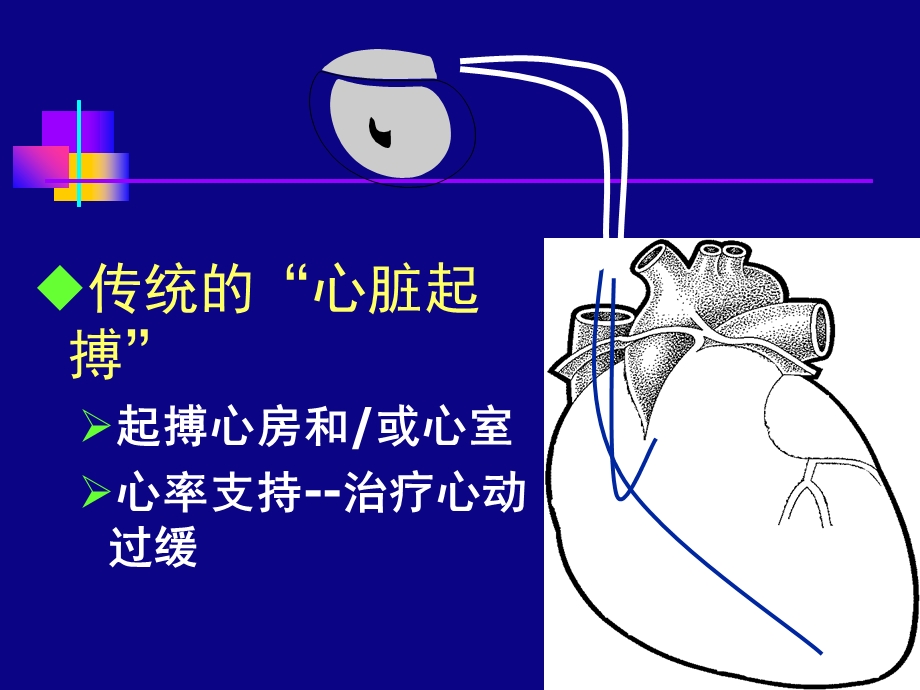 《起搏治疗进展》PPT课件.ppt_第2页