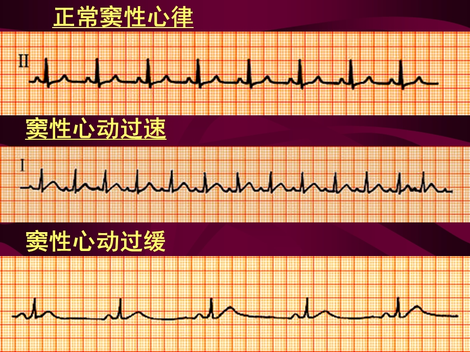 心电图讲课ppt课件.ppt_第2页