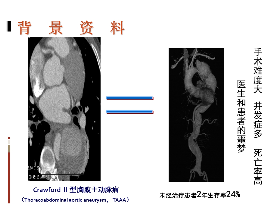 常温胸腹主动脉替换.ppt_第2页