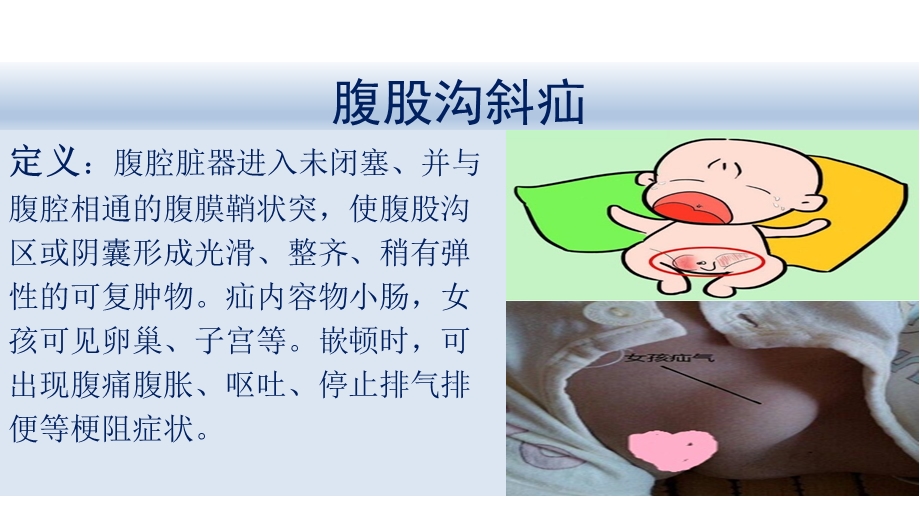 小儿普外科常见病及护理要点.ppt_第2页