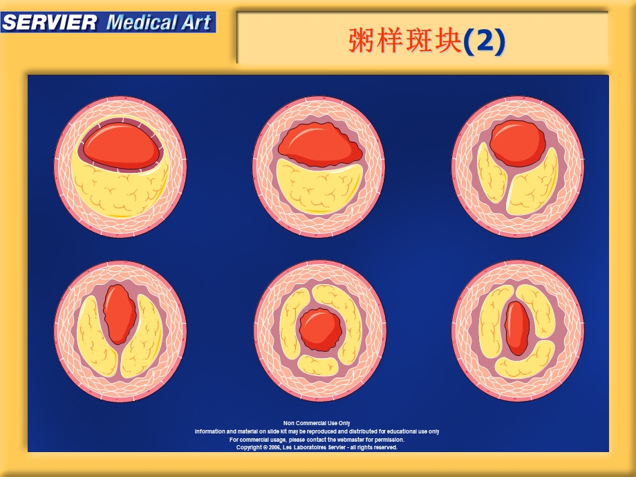 动脉粥样硬化精美图片.ppt_第3页