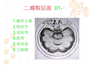 小儿头颅CT图谱.ppt