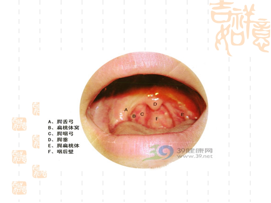 咽部常见疾病护理常规.ppt_第2页