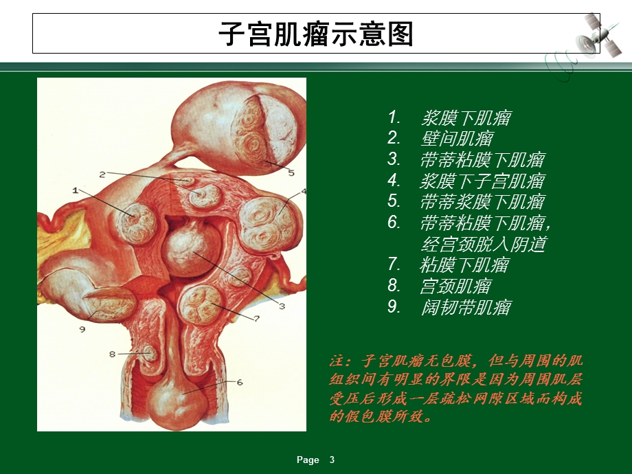 子宫肌瘤的超声诊断.ppt_第3页