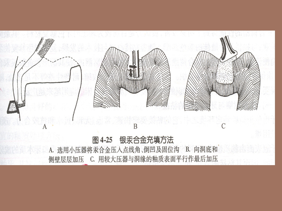 充填材料玻璃离子.ppt_第2页