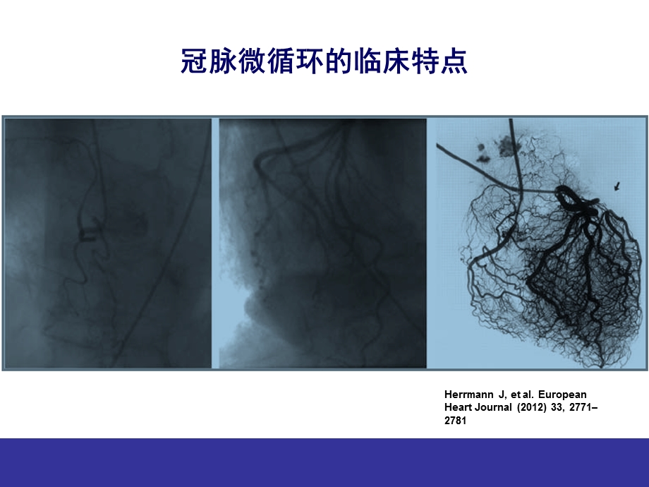 冠脉微血管病变的临床特点与防治-草稿.ppt_第3页