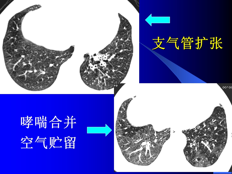 CT的肺功能性成像及其应用.ppt_第3页